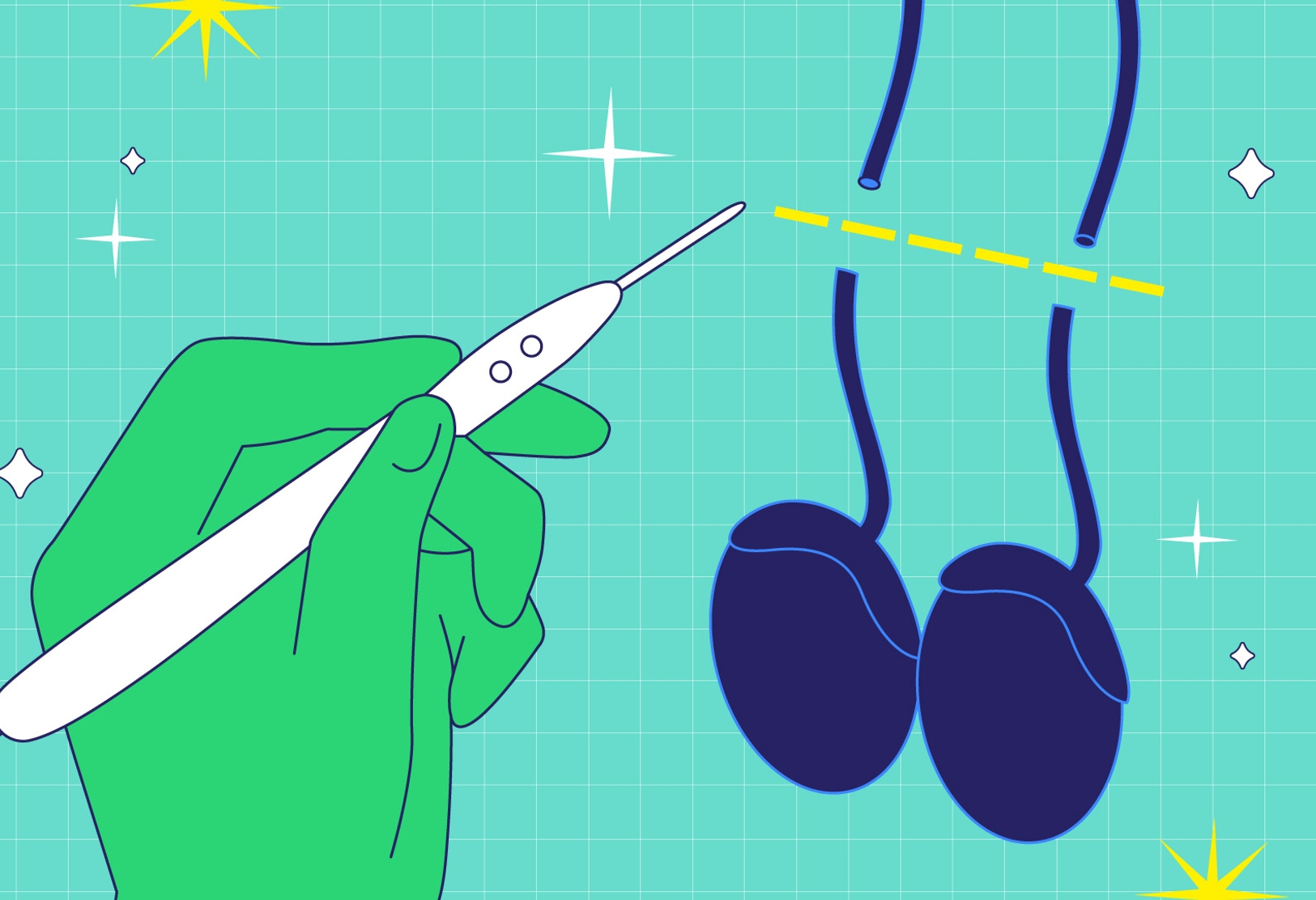 Vasectomy FAQs